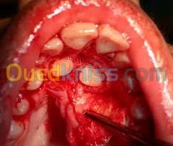 Chirurgie buccale