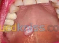 Chirurgie buccale