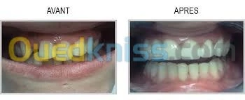 prothèses  dentaires