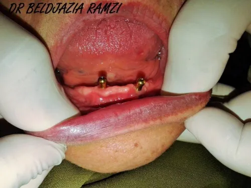 Implantologie Dentaire