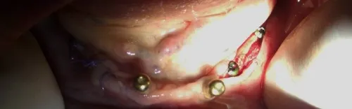 Implantologie Dentaire