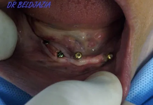 Implantologie Dentaire