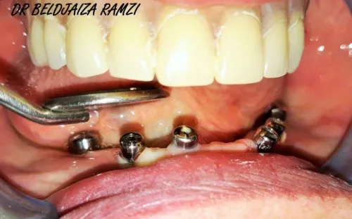 Implantologie Dentaire