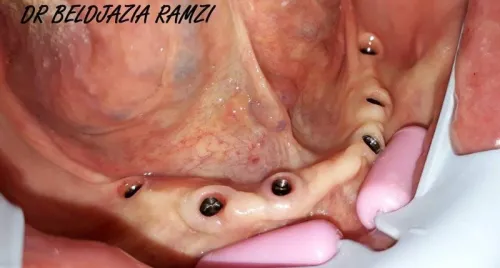 Implantologie Dentaire