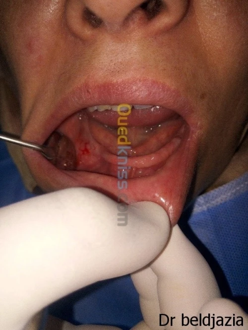 Implantologie Dentaire