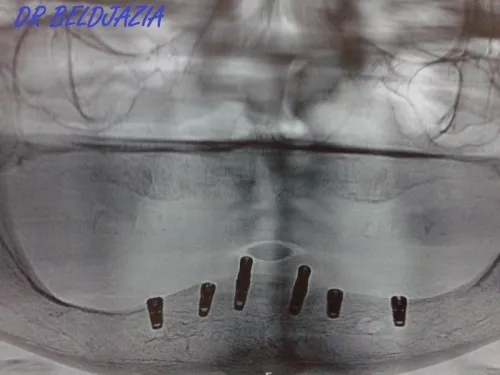 Implantologie Dentaire