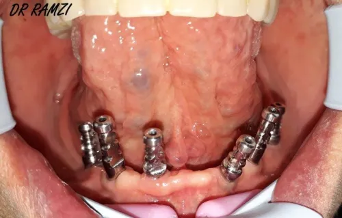 Implantologie Dentaire