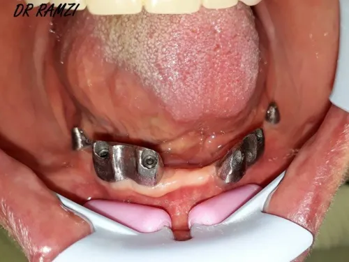 Implantologie Dentaire