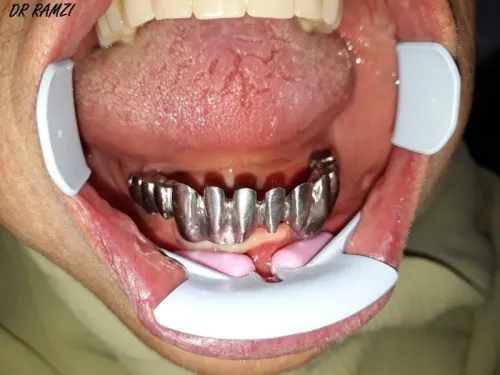 Implantologie Dentaire