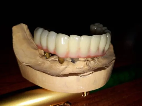 Implantologie Dentaire