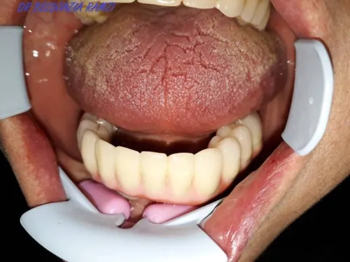 Implantologie Dentaire