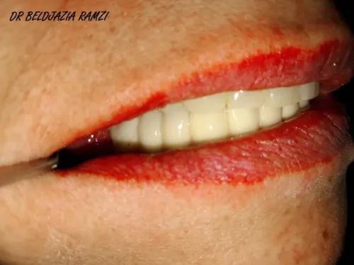 Implantologie Dentaire