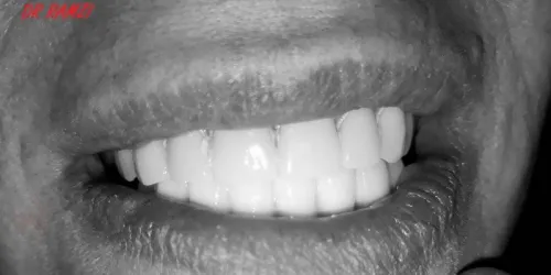 Implantologie Dentaire