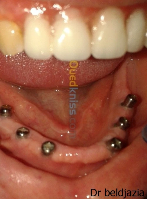 Implantologie Dentaire