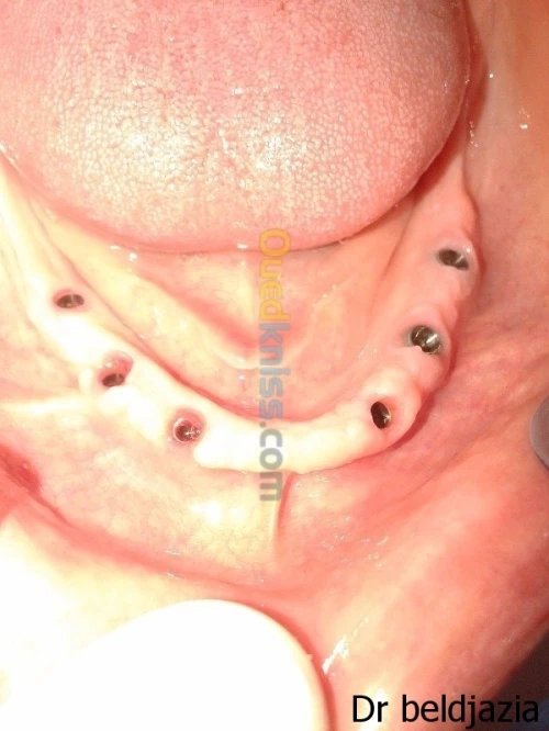 Implantologie Dentaire