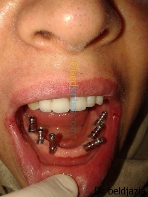 Implantologie Dentaire