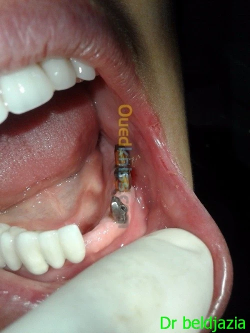 Implantologie Dentaire