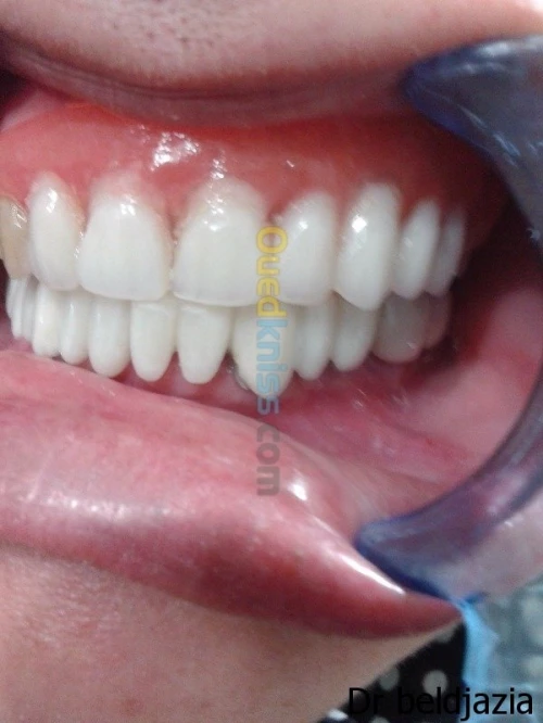 Implantologie Dentaire