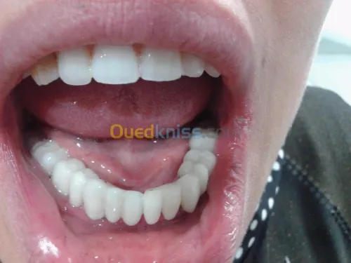 Implantologie Dentaire