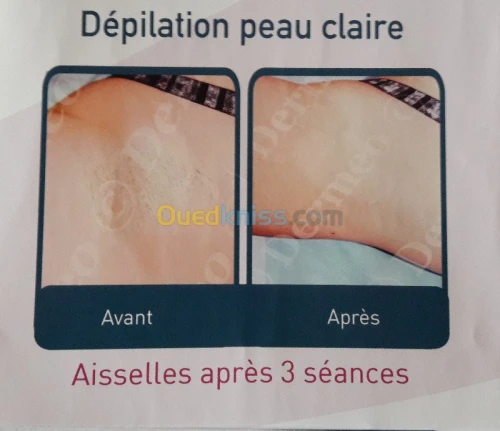 Epilation définitive  au laser...