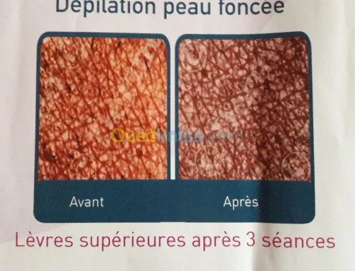 Epilation définitive  au laser...