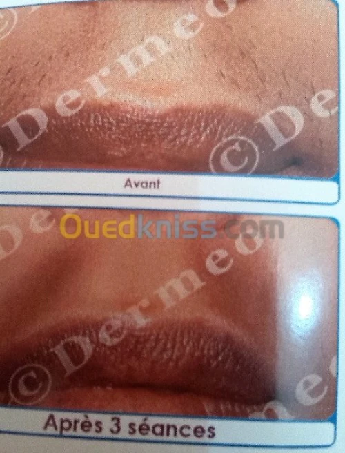 Epilation définitive  au laser...