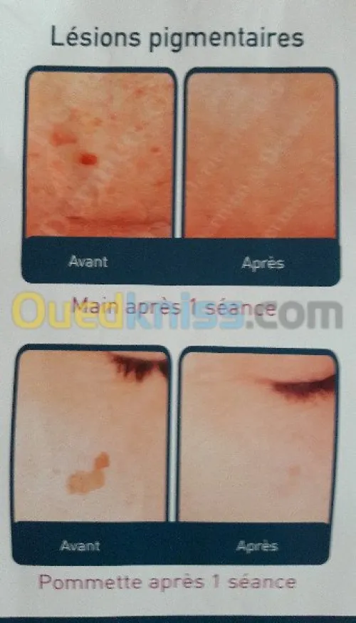 Epilation définitive  au laser...