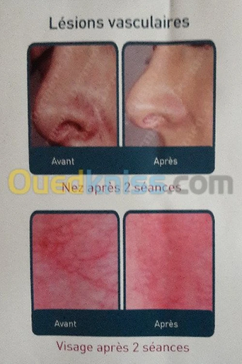 Epilation définitive  au laser...