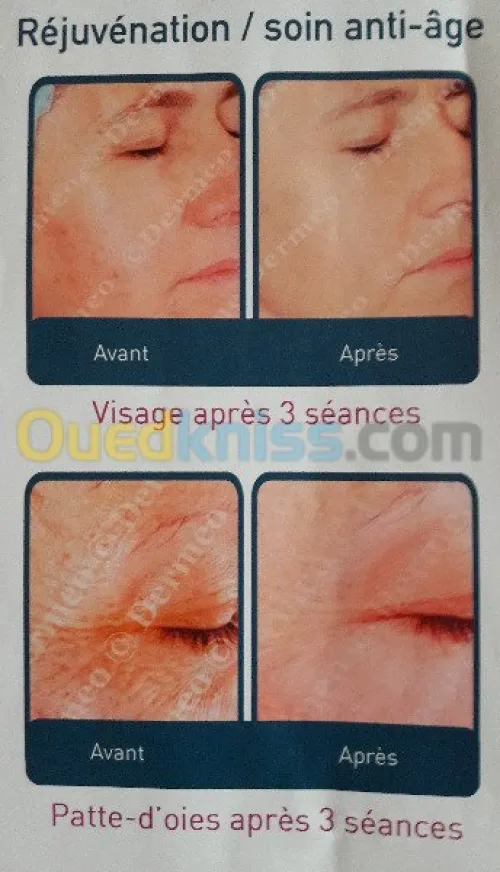 Epilation définitive  au laser...