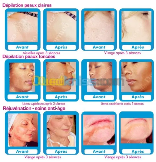 Epilation définitive  au laser...