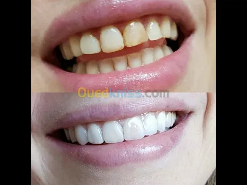 Dentisterie esthétique 