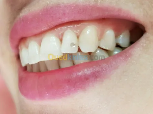 Dentisterie esthétique 