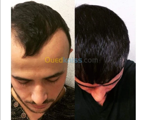 greffe de cheveux