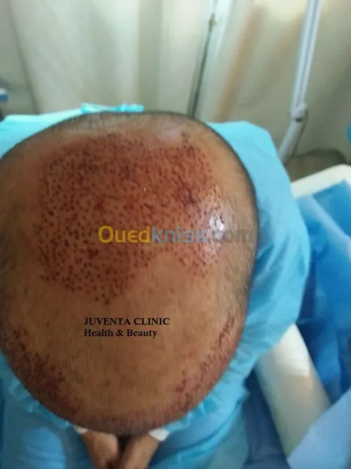 greffe de cheveux FUE , زراعة الشعر , 