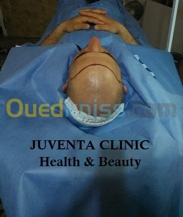 greffe de cheveux FUE , زراعة الشعر , 