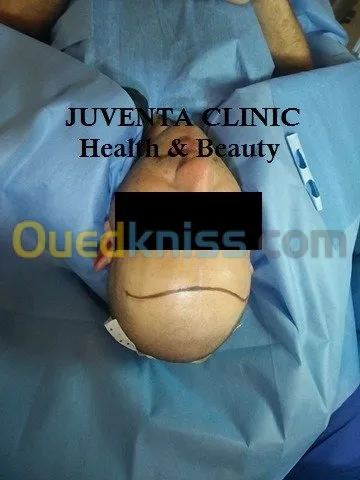 greffe de cheveux FUE , زراعة الشعر , 
