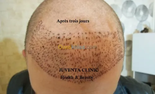 greffe de cheveux FUE , زراعة الشعر , 