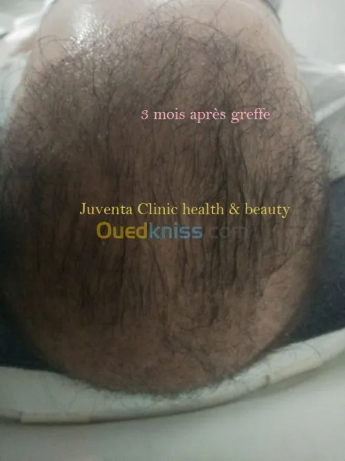 greffe de cheveux FUE , زراعة الشعر , 