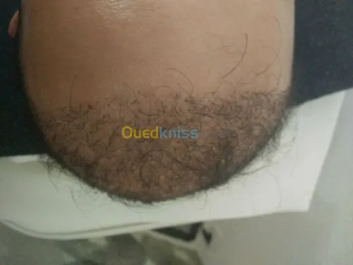 greffe de cheveux FUE , زراعة الشعر , 
