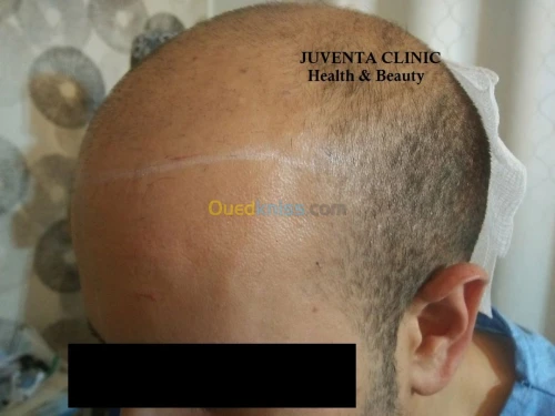 greffe de cheveux FUE , زراعة الشعر , 