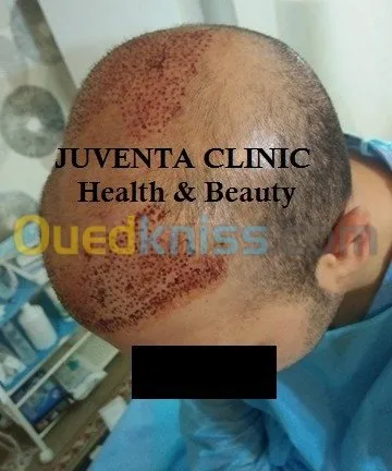 greffe de cheveux FUE , زراعة الشعر , 