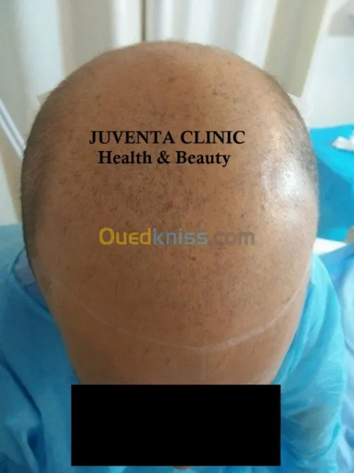greffe de cheveux FUE , زراعة الشعر , 
