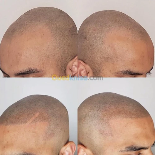 transplantation capillaire
