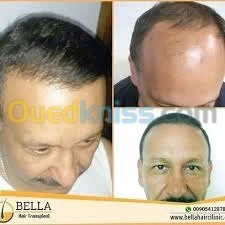 transplantation capillaire