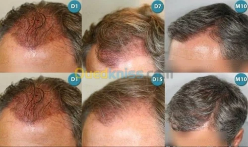 transplantation capillaire