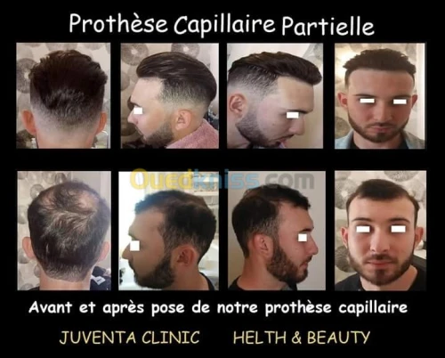 prothese capillaire 