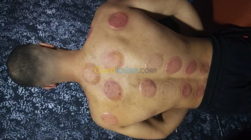 (Cupping thérapie)الحجامة و التدليك