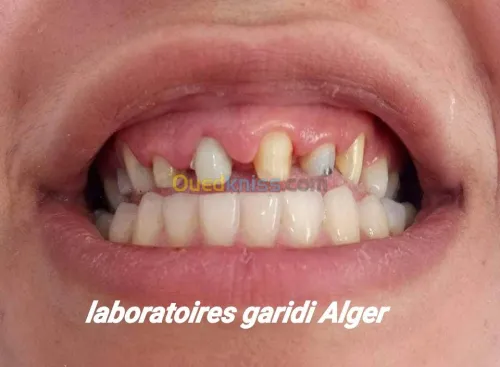 Prothèse dentaire de luxe 