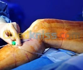 Traitement des varices sans chirurgie