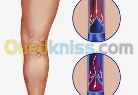 Traitement des varices sans chirurgie